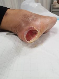 testimoni CMX kencing manis