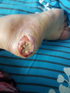 testimoni CMX kencing manis