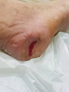 testimoni CMX kencing manis