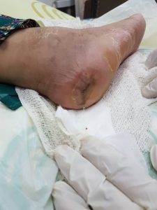 testimoni CMX kencing manis